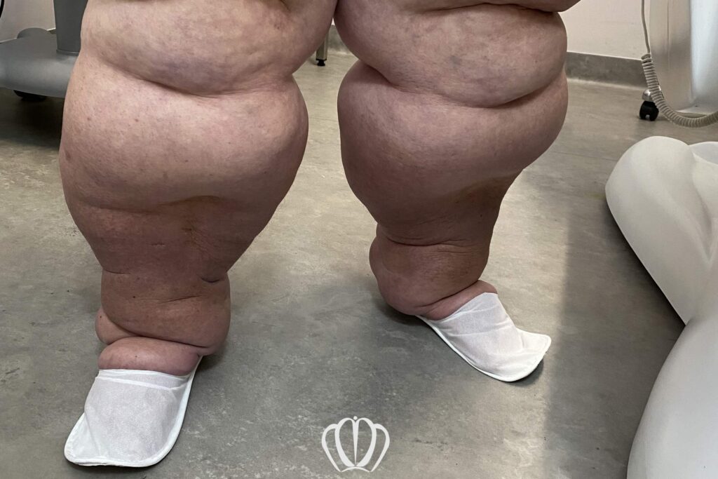 OBRZĘKI SĄ OBJAWEM CHOROBY SERCA, NEREK LUB UKŁADU ŻYLNEGO