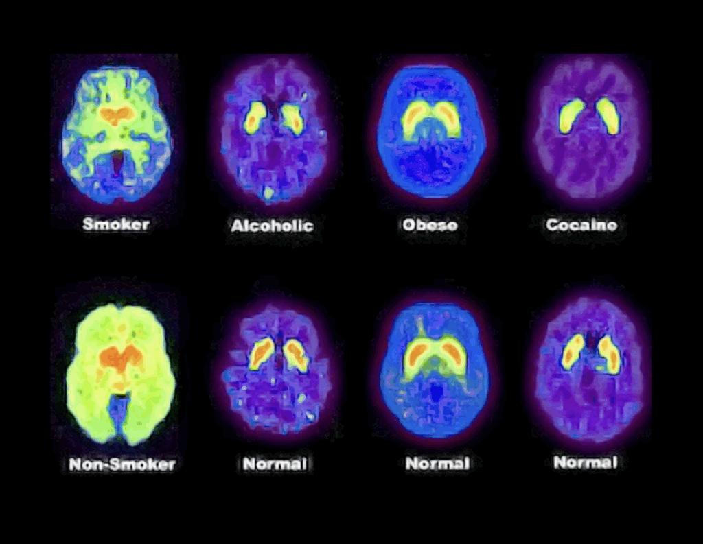 Wpływ różnych bodźców na wydzielanie dopaminy w mózgu oraz zmiany w aktywności centralnego układu nerwowego podobne w otyłości, w uzależnieniu od kokainy czy alkoholu.